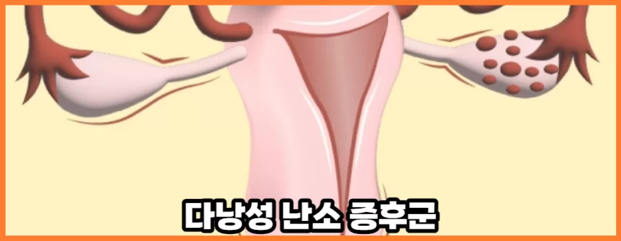 다낭성 난소 증후군 원인과 생리 치료방법