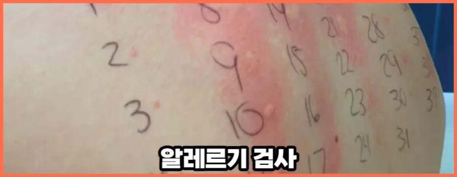 알레르기 검사 비용 건강보험 알아보기