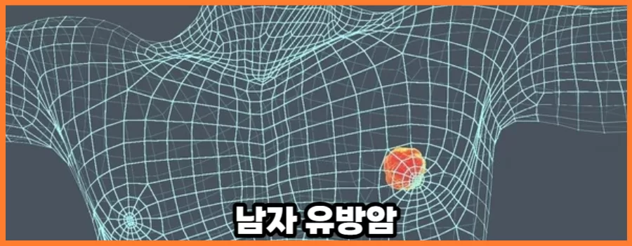 남자도 걸리는 유방암 증상 파악하기