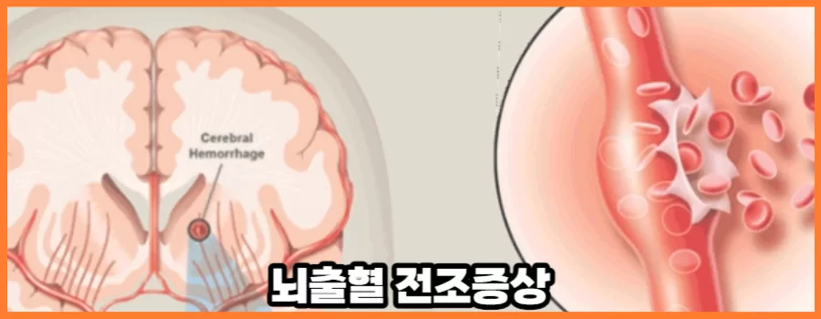 뇌출혈 전조증상이 무서운 이유