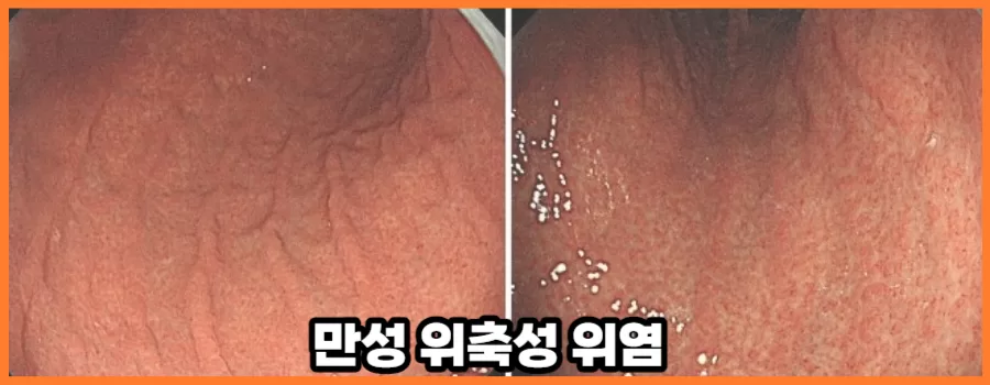 만성 위축성 위염 방치하면 위암에 걸릴수도 있다