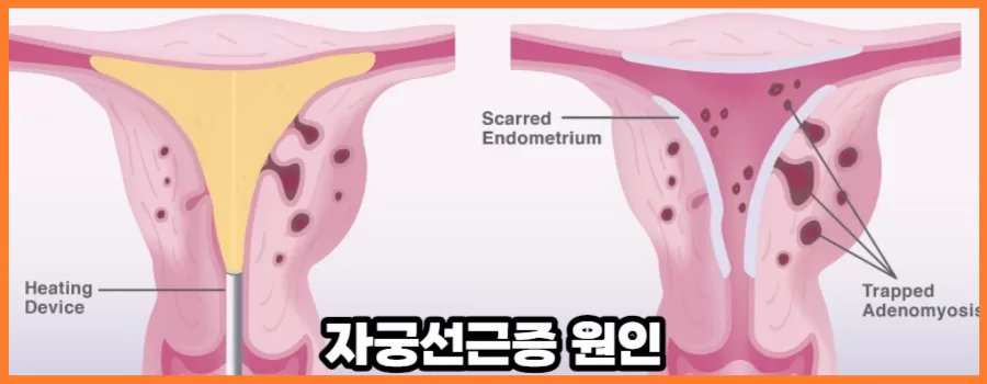 자궁선근증 원인과 임신확률 알아보기