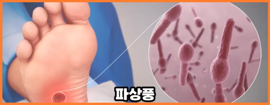 파상풍 초기증상 그리고 주사기간 안내