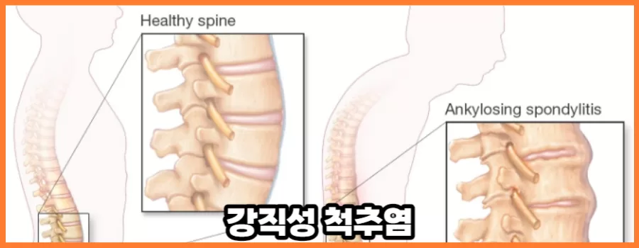 허리가 빳빳해진다면 강직성 척추염 증상