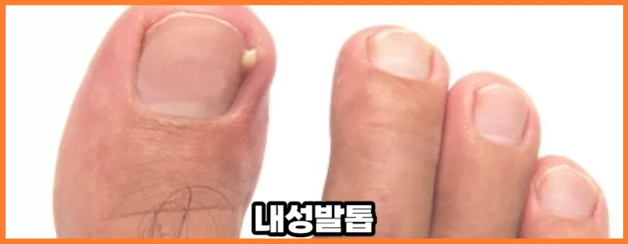 내성발톱 자가치료 간단하다