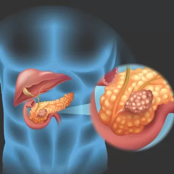 당뇨병과 췌장암의 연관 위험성